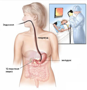 диагностика гастрита желудка