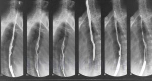 рентген пищевода и желудка