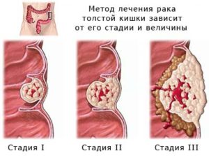 рак толстого кишечника