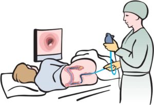 фиброколоноскопия кишечника