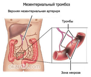 тромбоз кишечника